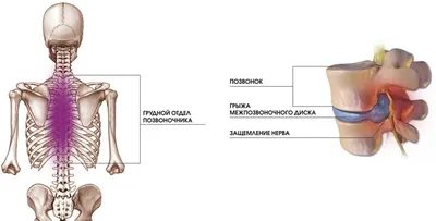 Грыжа грудного отдела позвоночника: симптомы и лечение | Клиника Temed