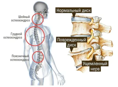 Как лечить остеохондроз шейно - грудного отдела позвоночника?