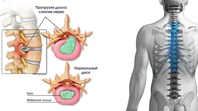 Лечение протрузии грудного отдела позвоночника в Екатеринбурге - Новая  больница