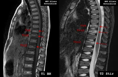МРТ грудного отдела позвоночника в Новосибирске – цены в клинике «МРТ  Альянс»
