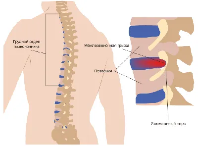 Грыжи шейного и грудного отдела позвоночника. - Первая Медицинская Клиника