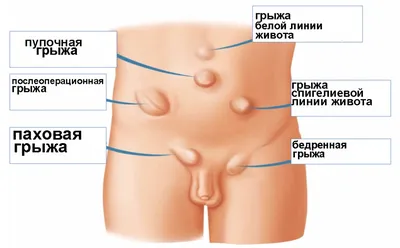 Операция по удалению белой грыжи живота. - «Большой отзыв. Мои впечатления.  Почему появилась грыжа? Как подготовится? Что взять с собой? Как  восстанавливалась? Осложнения после операции. Фото рубца после 2 месяцев.»  | отзывы