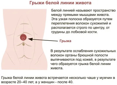 Операция по удалению грыжи белой линии живота