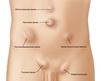 Грыжа белой линии живота. Диагностика и операция - Исамутдинова Г. М.