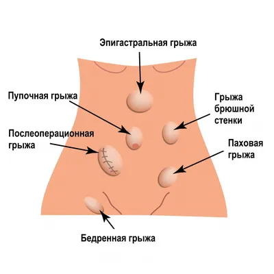 Грыжи белой линии живота