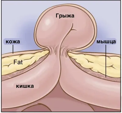 Диастаз после родов: причины появления, симптомы, лечение | Блог Daily  Medical