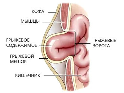 Как определить наличие паховой грыжи у женщин - блог Виртус