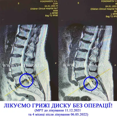 Пупочная грыжа у взрослых: симптомы, причины, лечение, профилактика в  домашних условиях