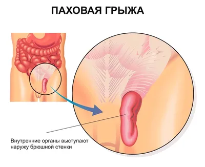 Лечение межпозвоночной грыжи - Медцентр \"Диагност\"