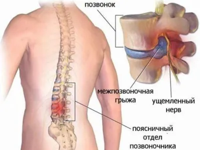 Симптомы и лечение грыжи позвоночника: 3 эффективных подхода в медицине