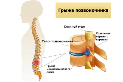 Межпозвонковая грыжа пояснично-крестцового отдела позвоночника - операция,  лечение, цены