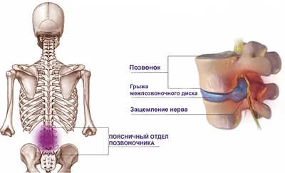 Протрузия и грыжа у пожилых: симптомы, диагностика и лечение