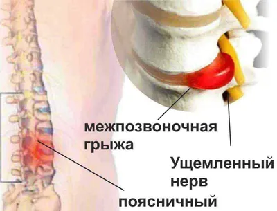 Межпозвоночная грыжа пояснично-крестцового отдела позвоночника — лечение  без операции | Клиника Temed