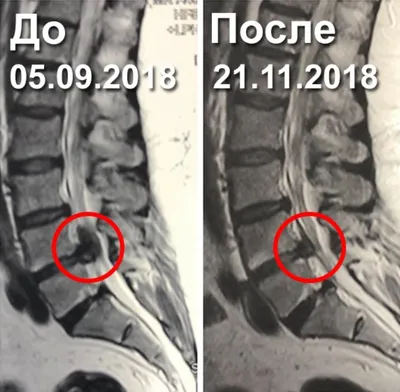 Большая позвоночная грыжа - Доктор Позвонков