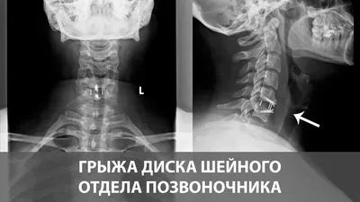 МЕЖПОЗВОНОЧНЫЕ ГРЫЖИ и СТЕНОЗЫ ПОЗВОНОЧНОГО КАНАЛА