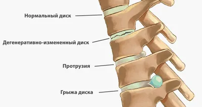 Лечение грыжи позвоночника: причины, симптомы и лечение