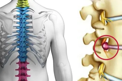 Грыжа в поясничном отделе позвоночника | Пикабу