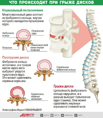 Причины возникновения грыжи позвоночника