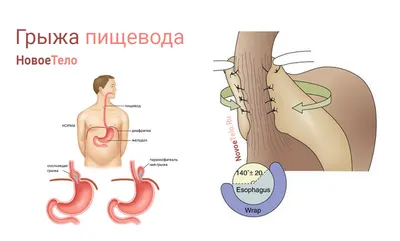 Диафрагмальная грыжа - симптомы, диагностика | Егиев Валерий Николаевич