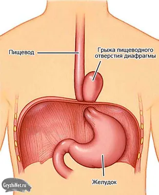 Грыжа пищеводного отверстия диафрагмы. Причины возникновения.  Кинезиологическое лечение