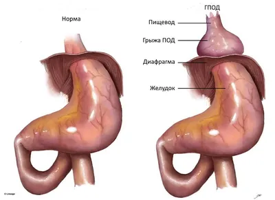 Грыжа пищеводного отверстия диафрагмы: причины, жалобы, лечение - Сиюхов  Руслан Шумафович