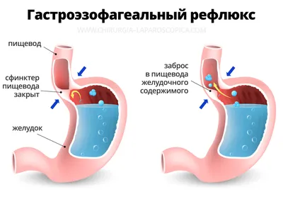 Грыжа пищеводного отверстия. Какие упражнения могут помочь? - YouTube