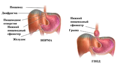 Сегодня разберем, почему необходимо прибегать к оперативному лечению грыжи  пищеводного отверстия диафрагмы (ГПОД) и пищевода Барретта… | Instagram