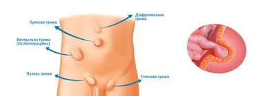 Почему возникает грыжа и как ее вылечить?