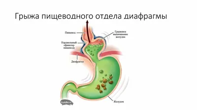 Послеоперационная грыжа: лечение, пластика, операция по удалению в СПб -  цена