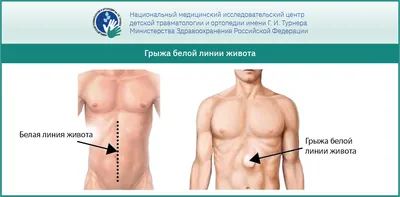 Грыжа пищеводного отверстия диафрагмы