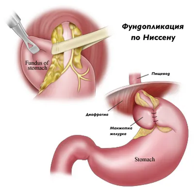 Лечение лапароскопической фундопликации при грыже пищеводного отверстия  диафрагмы в Ташкенте