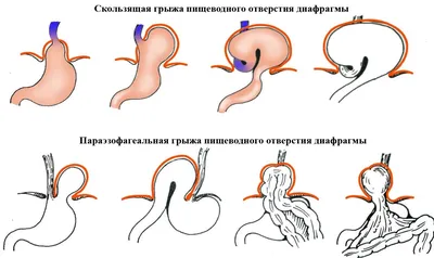 Грыжа желудка фото