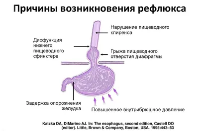 Грыжа пищеводного отверстия диафрагмы: симптомы, диагностика, лечение |  Клиника Эксперт