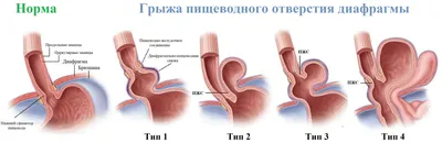 Грыжи пищеводного отверстия диафрагмы (ГПОД) | FDMClinic.com