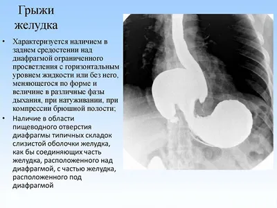 Грыжа пищеводного отверстия диафрагмы, ГПОД - YouTube