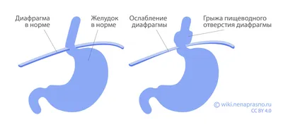 Грыжа? | Портал радиологов