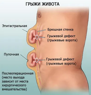 Оперативное лечение грыж живота в Клинике Боли