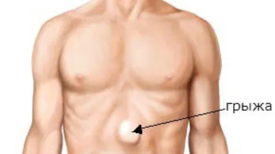 ☆ Лечение послеоперационной грыжи - современый центр лечения грыж