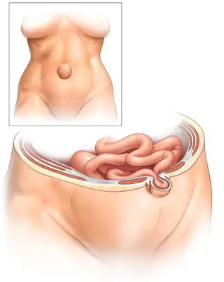 Грыжа белой линии живота - диагностика и лечение в Москве. Консультация  врача.