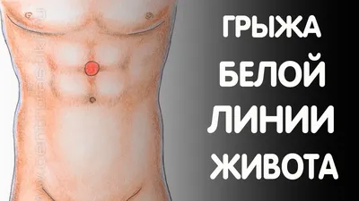 Грыжи живота: симптомы, диагностика и лечение в клинике Universum Clinic