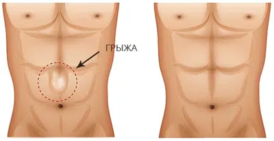 Операция по удалению белой грыжи живота. - «Большой отзыв. Мои впечатления.  Почему появилась грыжа? Как подготовится? Что взять с собой? Как  восстанавливалась? Осложнения после операции. Фото рубца после 2 месяцев.»  | отзывы