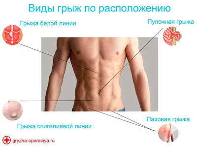 ✓ Что такое грыжа? Грыжей называют выход под кожу содержимого живота через  слабое отверстие в мышцах брюшной стенки. К грыжам живота… | Instagram