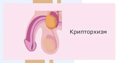 Крипторхизм – симптомы, причины, диагностика и лечение у мужчин в клинике  «Будь Здоров»