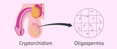 Крипторхизм: что это. Симптомы, причины, диагностика и лечение крипторхизма