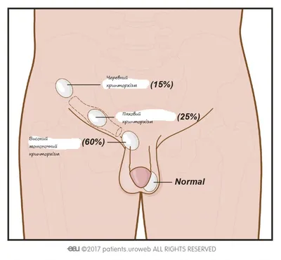 Крипторхизм - причины, симптомы, диагностика, лечение и профилактика