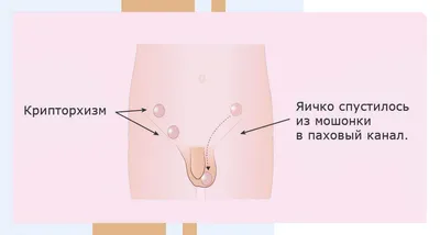 ✓Крипторхизм – это состояние, при... - Moscow_urocenter | Facebook