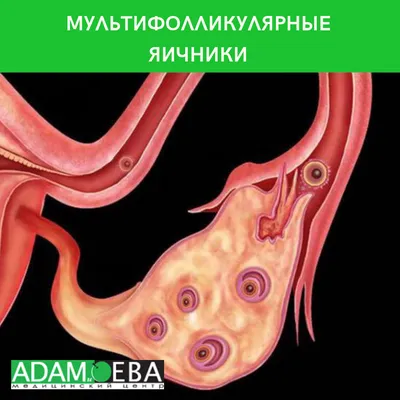 Виды кист яичников: какие они бывают, классификация и описание серозных,  геморрагических, муцинозных и других кист яичников у женщин, лечение в  Москве