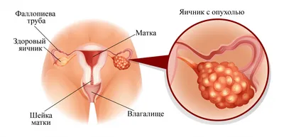Почему болит яичник и что с этим делать? — симптомы, диагностика, лечение в  НКЦ№2 (ЦКБ РАН)