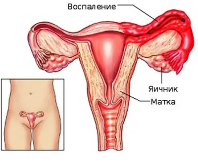 Дисфункция яичников и склерокистоз яичников