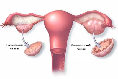Мультифолликулярные яичники: причины, симптомы и лечение в статье акушера  Волынец Г. В.